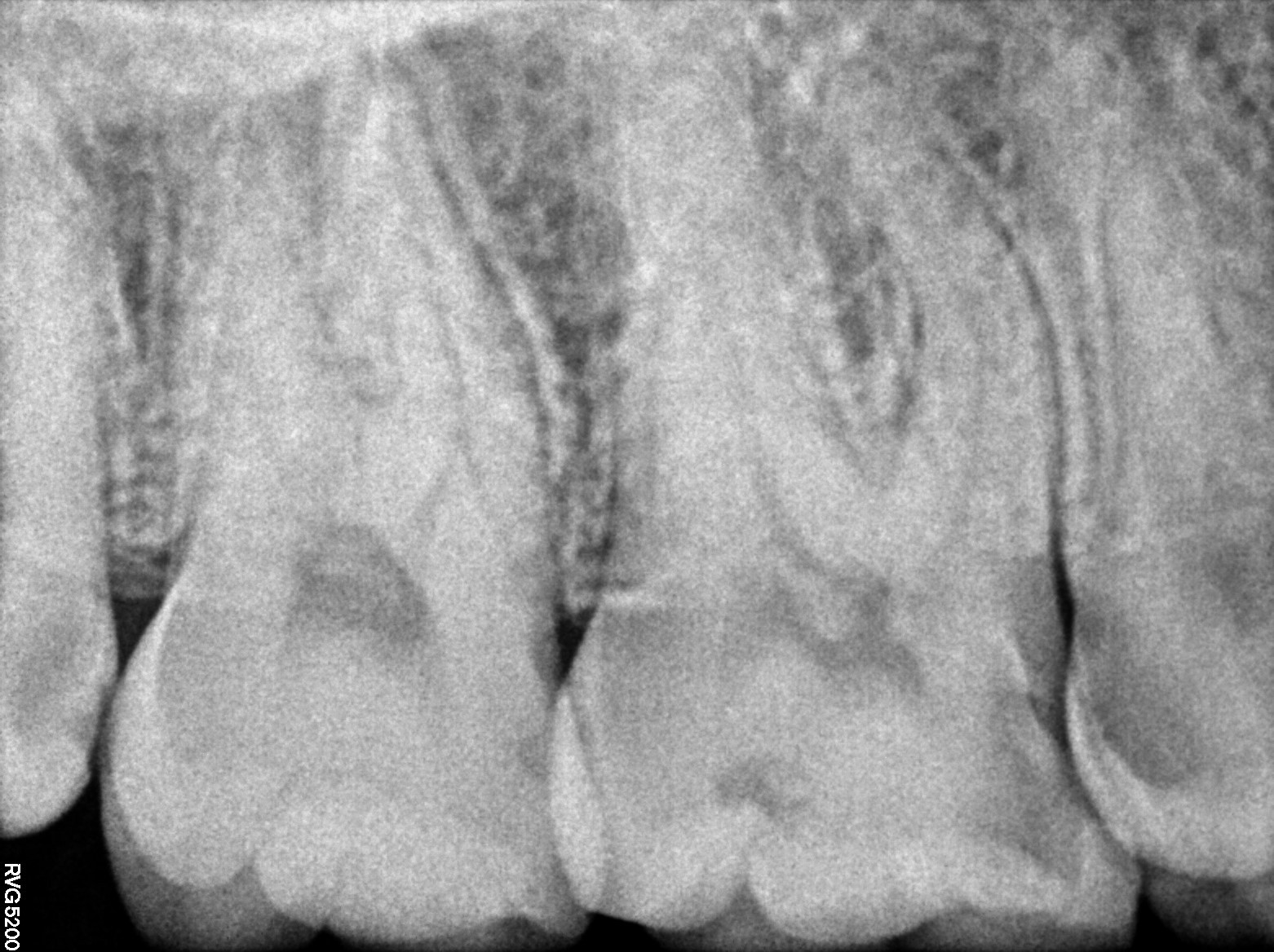 Dental X-ray